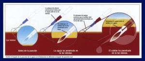CATÉTER INTRAVENOSO TERUMO® SURFLASH®